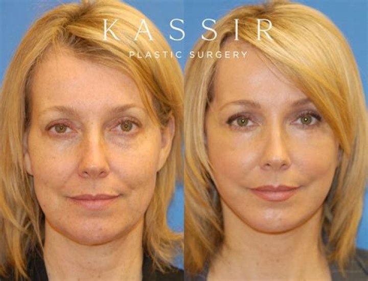 Has She Done Face Lift And Nose Job ·